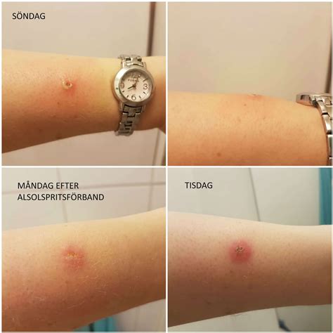 Infekterat sår